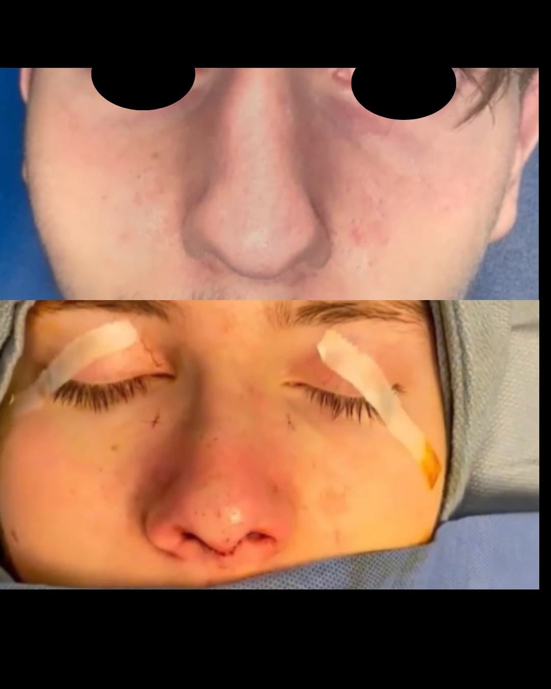 Male Rhinoplasty before and after, patient 4 of Dr. Salim Saba, view 2