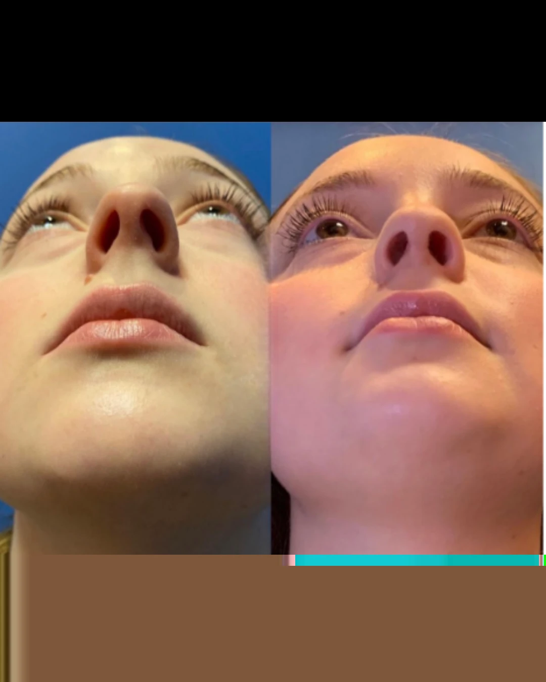 Female Rhinoplasty before and after, patient 5 of Dr. Salim Saba, view 3