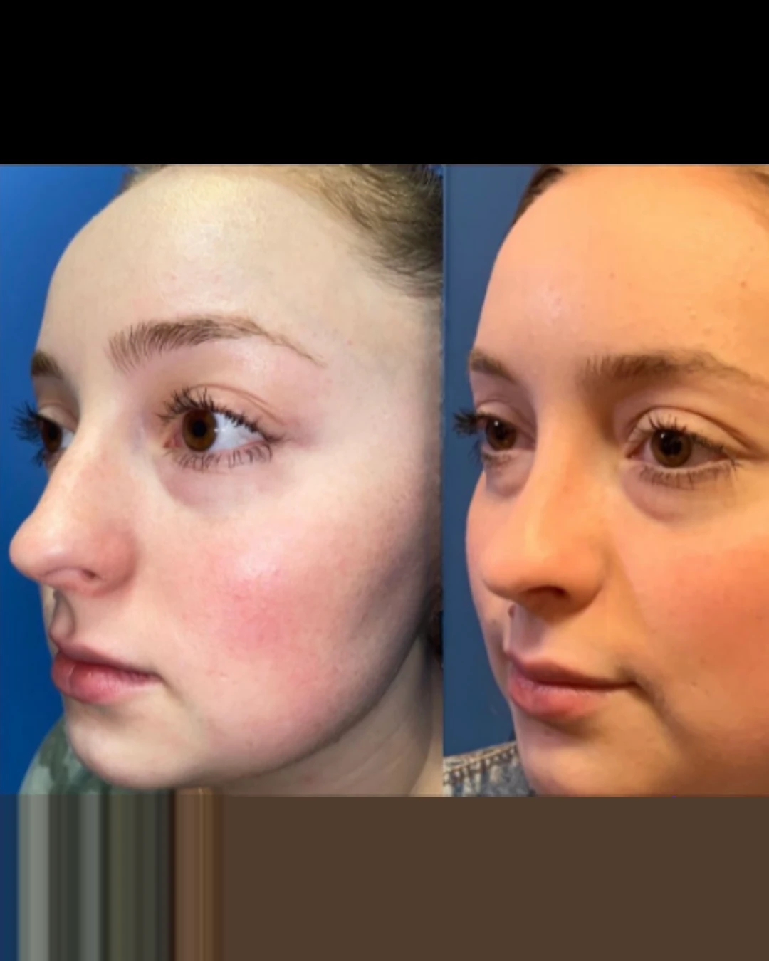Female Rhinoplasty before and after, patient 5 of Dr. Salim Saba, view 4