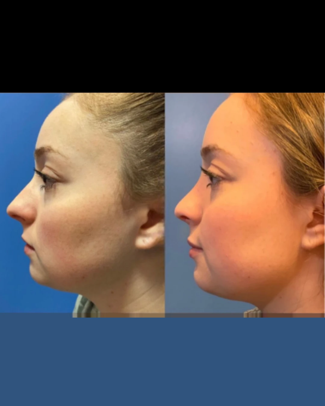 Female Rhinoplasty before and after, patient 5 of Dr. Salim Saba, view 2
