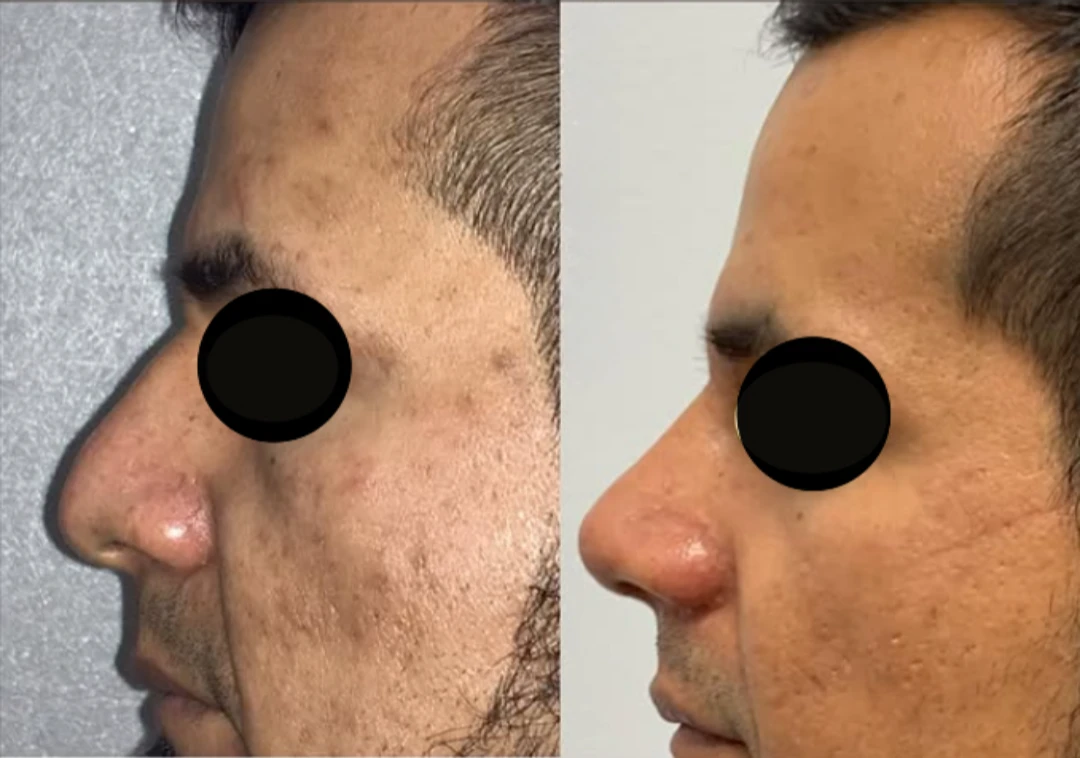 Male Rhinoplasty before and after, patient 9 of Dr. Salim Saba, view 1