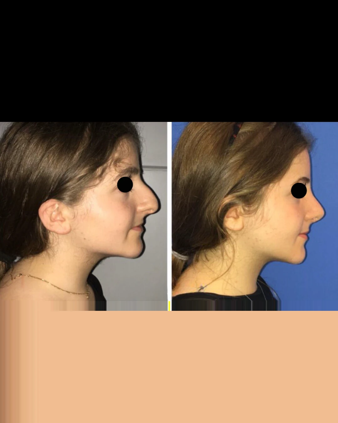 Female Rhinoplasty before and after, patient 7 of Dr. Salim Saba, view 1