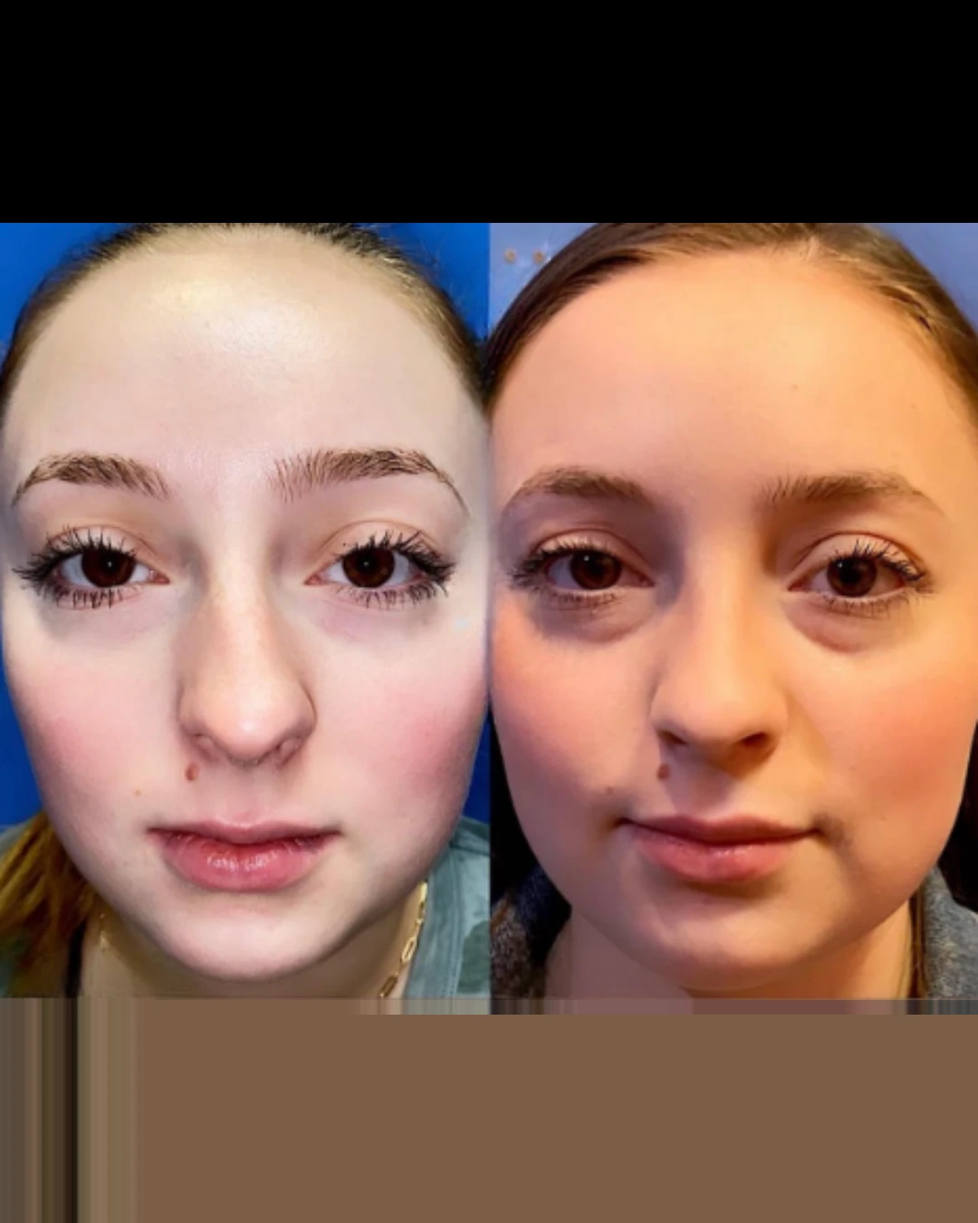 Female Rhinoplasty before and after, patient 5 of Dr. Salim Saba, view 1