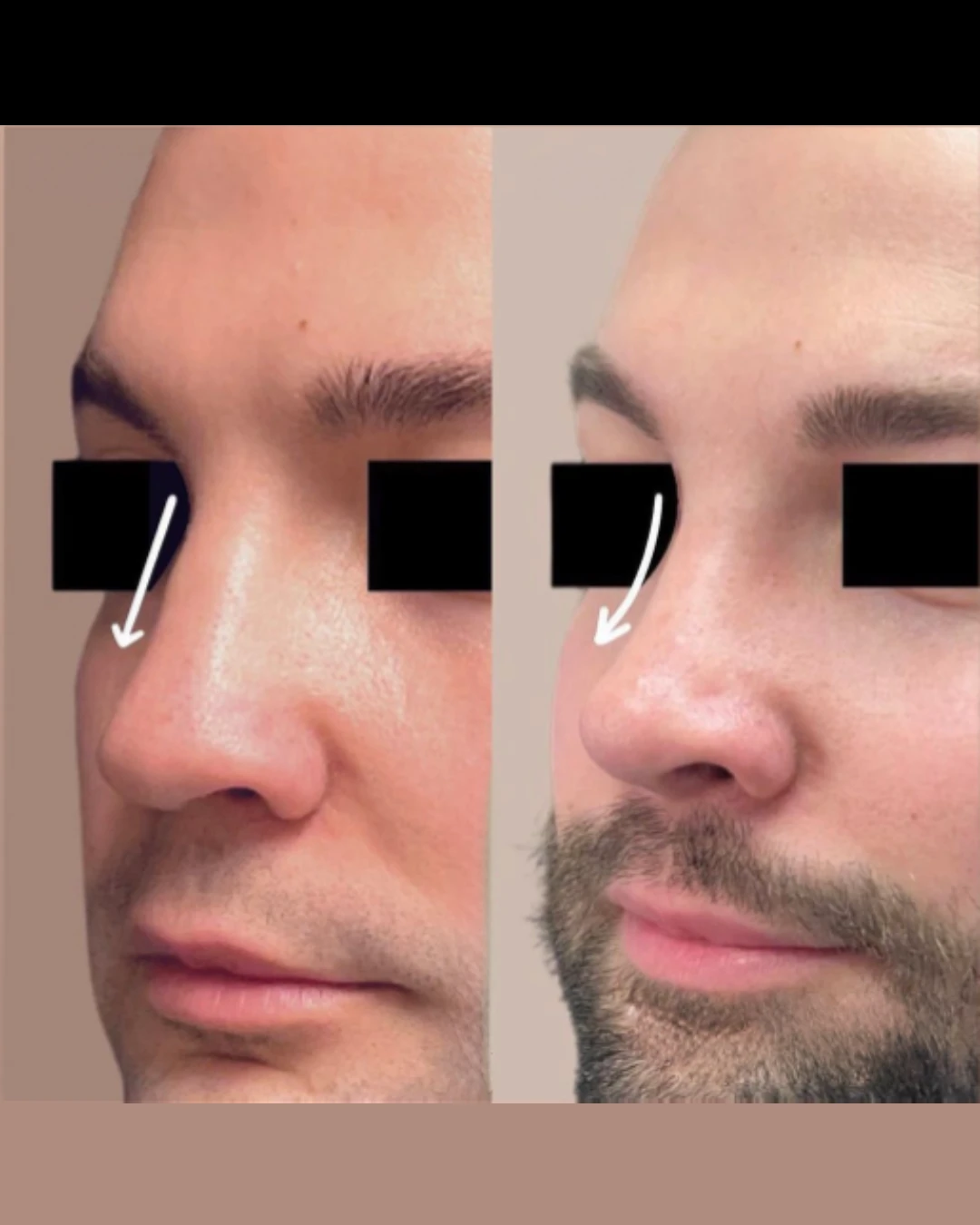 Male Rhinoplasty before and after, patient 1 of Dr. Salim Saba, view 3