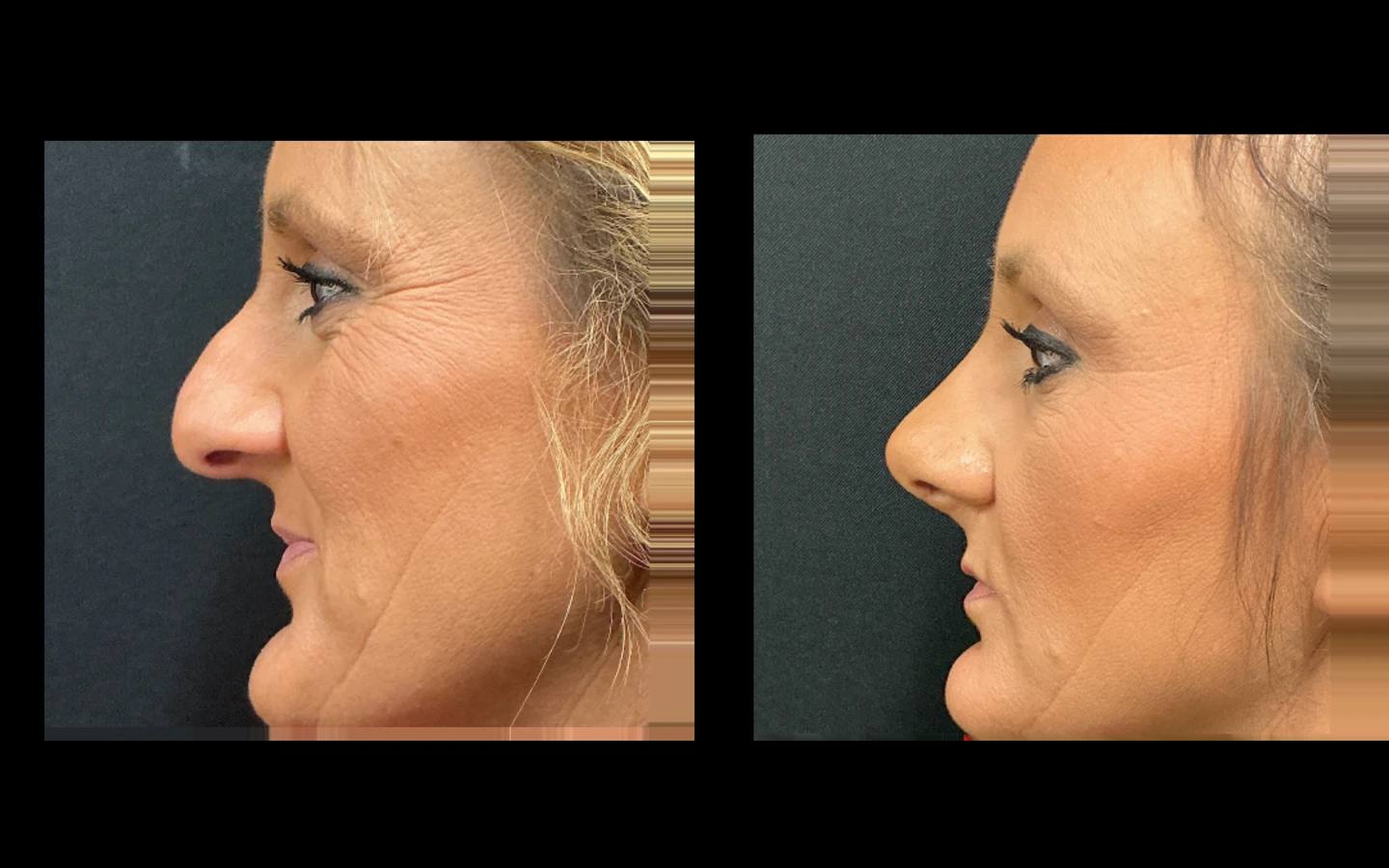 Female Rhinoplasty before and after, patient 11 of Dr. Salim Saba, view 1