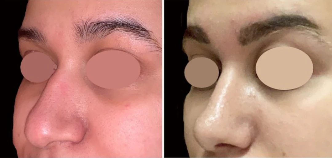 Female Rhinoplasty before and after, patient 8 of Dr. Salim Saba, view 1