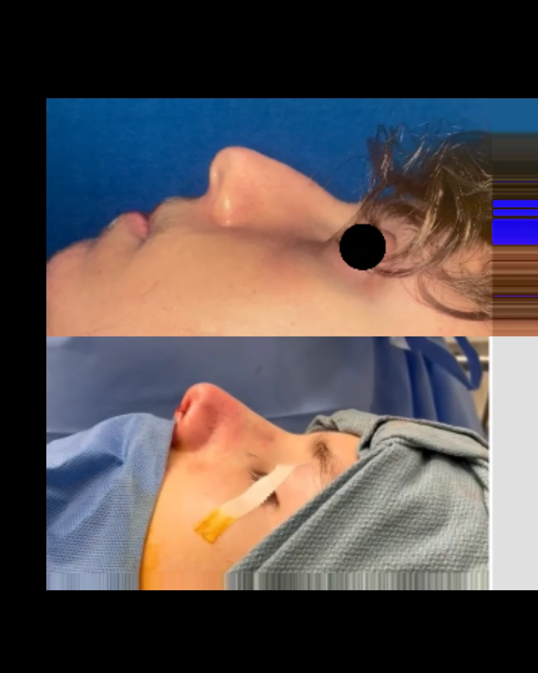 Male Rhinoplasty before and after, patient 4 of Dr. Salim Saba, view 1