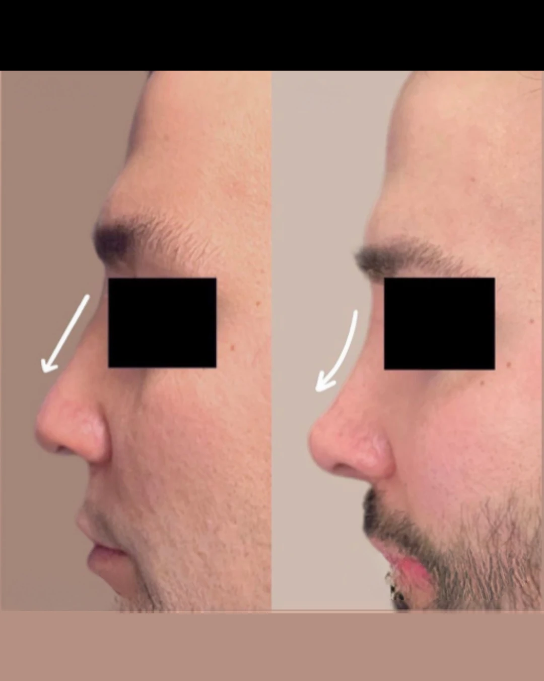 Male Rhinoplasty before and after, patient 1 of Dr. Salim Saba, view 2